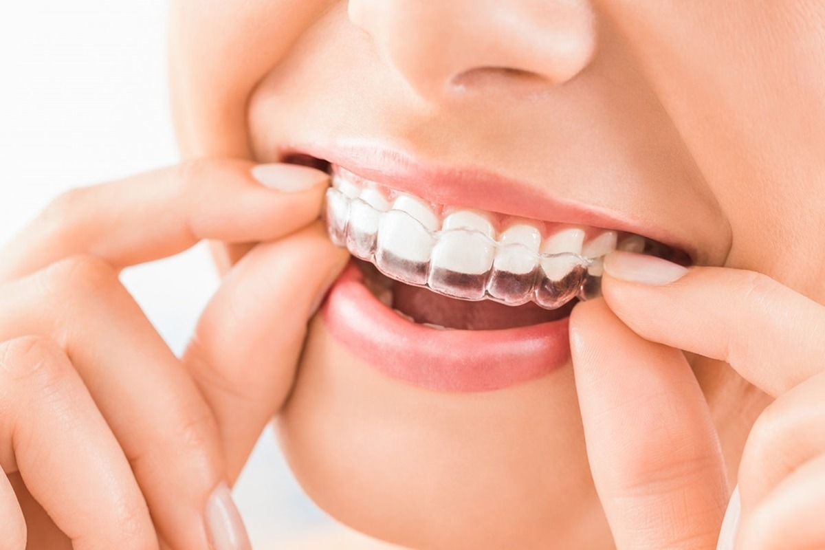 https://dentalife.com.np/clinic/wp-content/uploads/2023/11/clear-braces-ialign-nepal.jpg