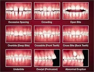 Teeth Braces in Nepal / Invisible Braces (Clear Aligners) - DentaLife Oral  Concern Pvt. Ltd.