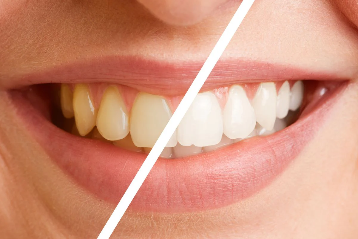 Teeth Whitening