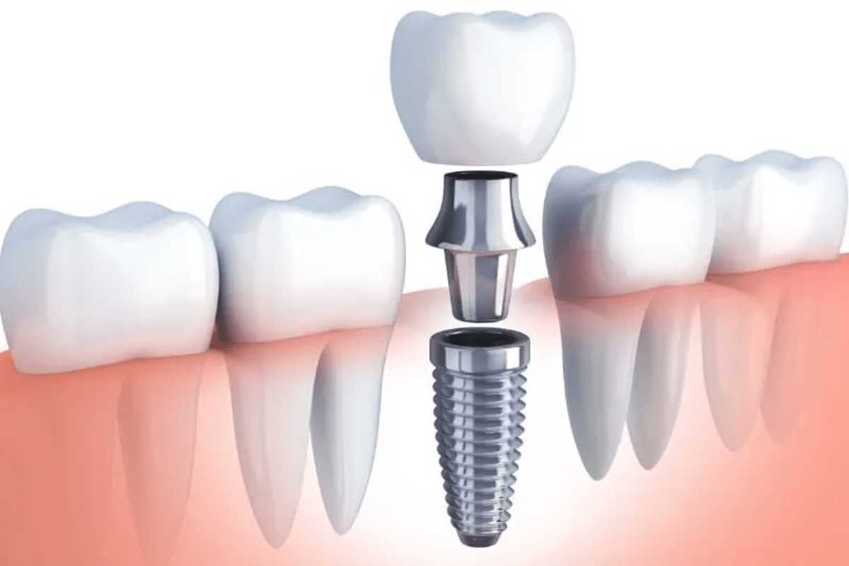 https://dentalife.com.np/wp-content/uploads/2023/11/dental-implant-nepal.png