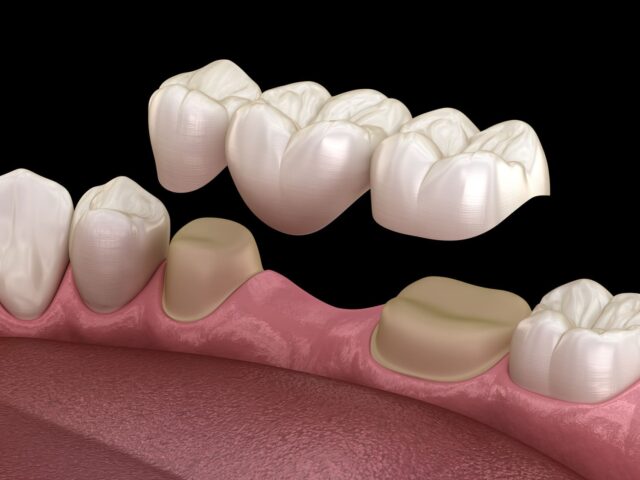 Dental Bridge