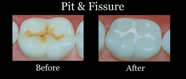 Pit Fissure