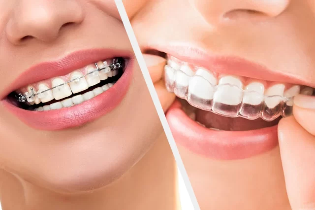 Dental Braces