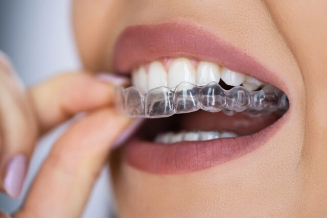 Clear Aligner 