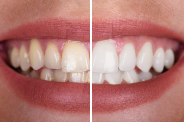 Teeth Whitening / Teeth Bleaching