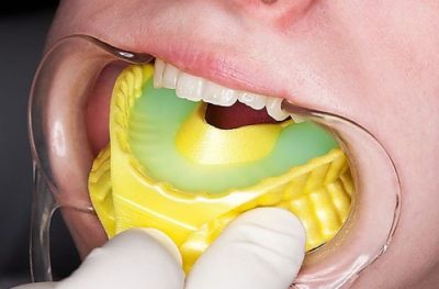 dental fluoride treatment