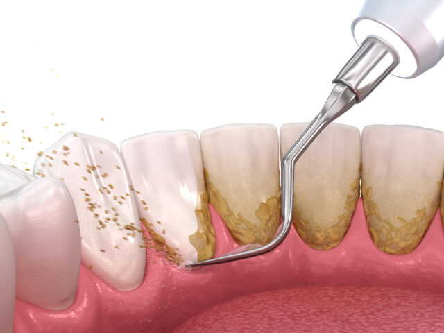 Teeth Scaling / Teeth Cleaning