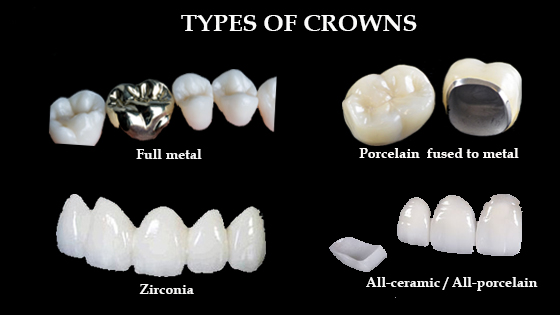 Dental crown Types