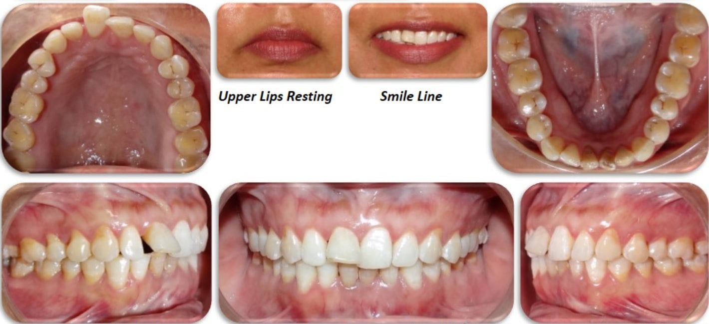 Discolored Tooth Treated with Direct Composite Veneer Discolored Tooth Treated with Direct Composite Veneer