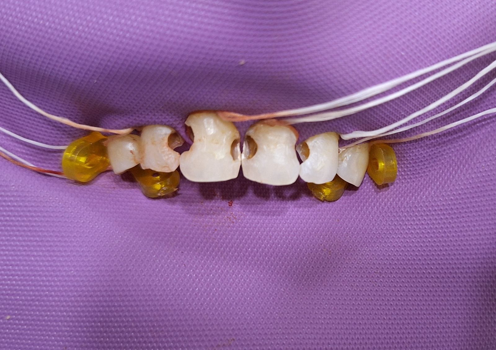 Discolored Tooth Treated with Direct Composite Veneer