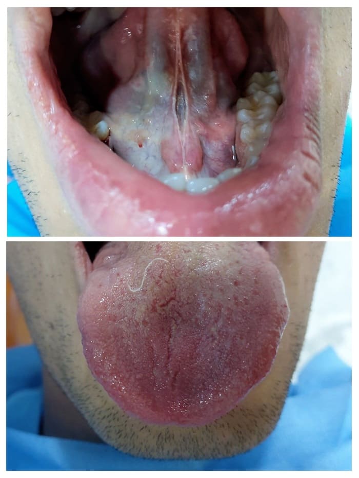 Discolored Tooth Treated with Direct Composite Veneer