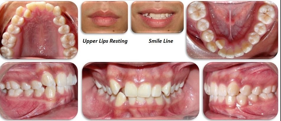 Discolored Tooth Treated with Direct Composite Veneer