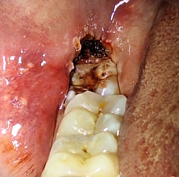 Discolored Tooth Treated with Direct Composite Veneer