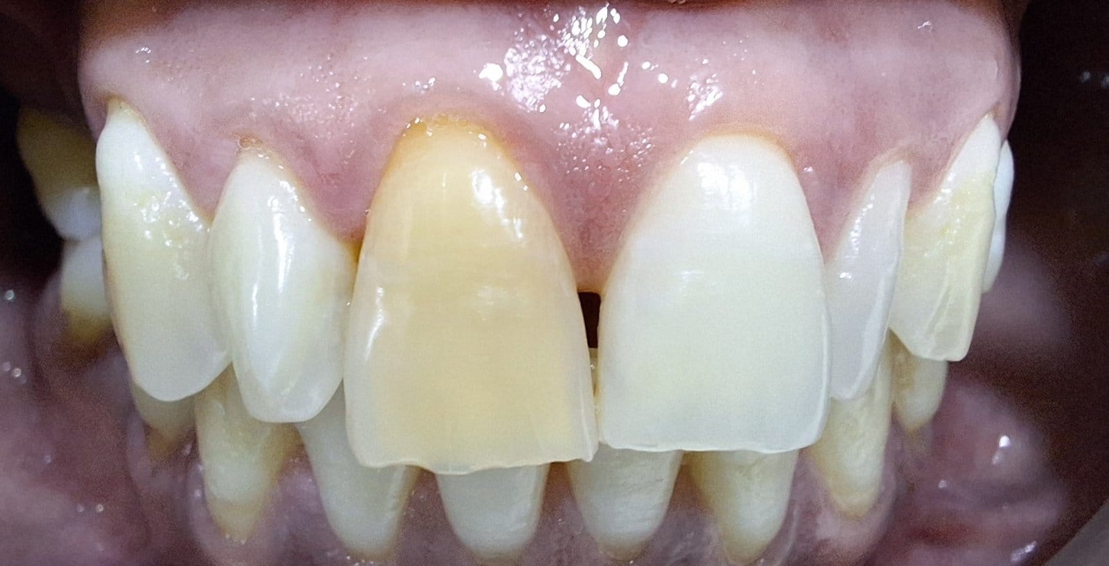 Discolored Tooth Treated with Direct Composite Veneer