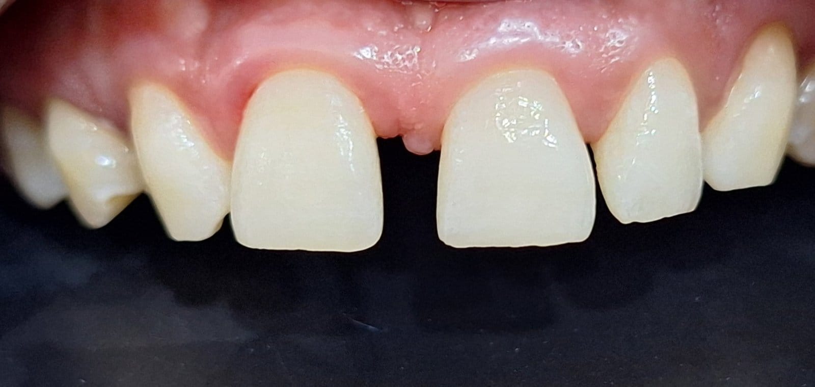 Discolored Tooth Treated with Direct Composite Veneer