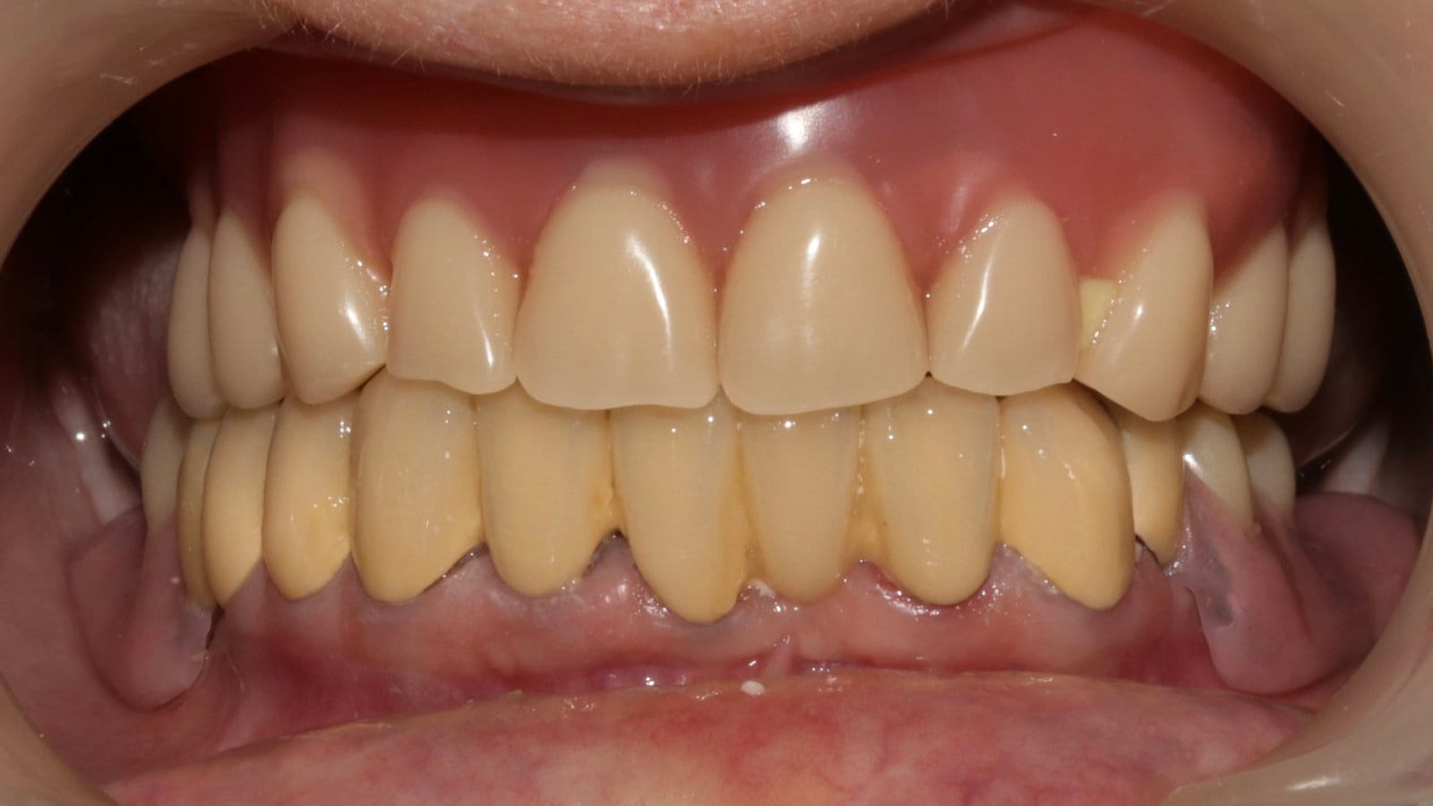 Discolored Tooth Treated with Direct Composite Veneer